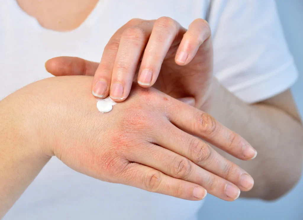 Best Anti-Itch Creams for Itchy Skin